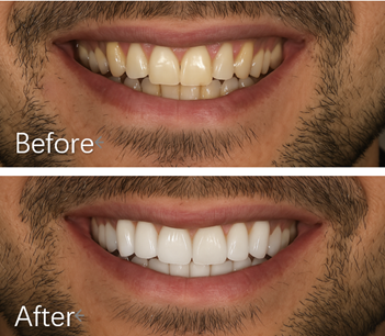 美學貼片 Before After