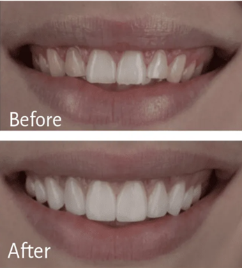 美學貼片 Before After