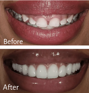 美學貼片 Before After