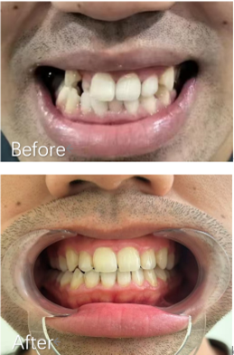 隱形矯正 Before After