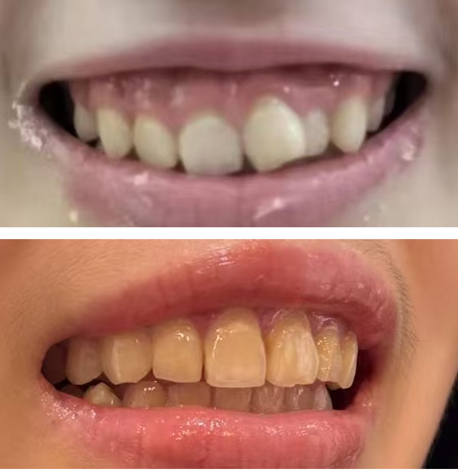 隱形矯正 Before After